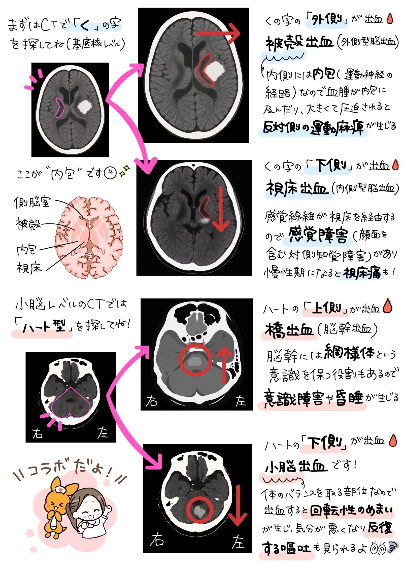 脳出血のCT　解説画像