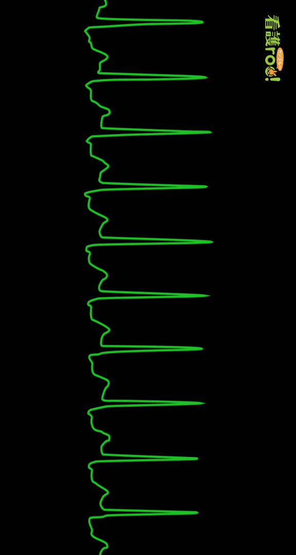 発作性上室頻拍（PSVT）の波形の例