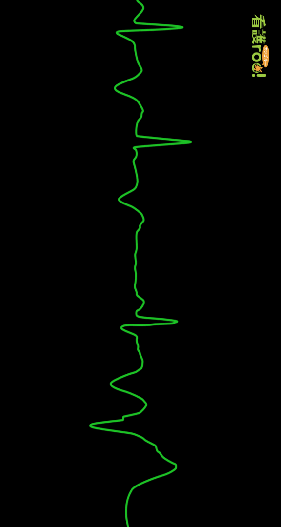 QT延長の波形の例