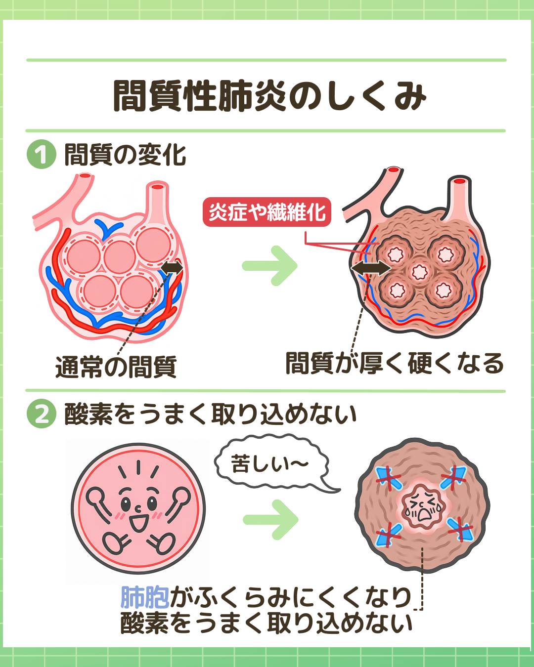 図解：間質性肺炎のしくみ。1. 間質の変化：肺胞壁を含む間質に炎症や繊維化が起こり、肺胞壁が厚く硬くなるイラスト。2. 酸素をうまく取り込めない：肺胞がふくらみにくくなり、酸素を取り込みづらくなるしくみを解説。