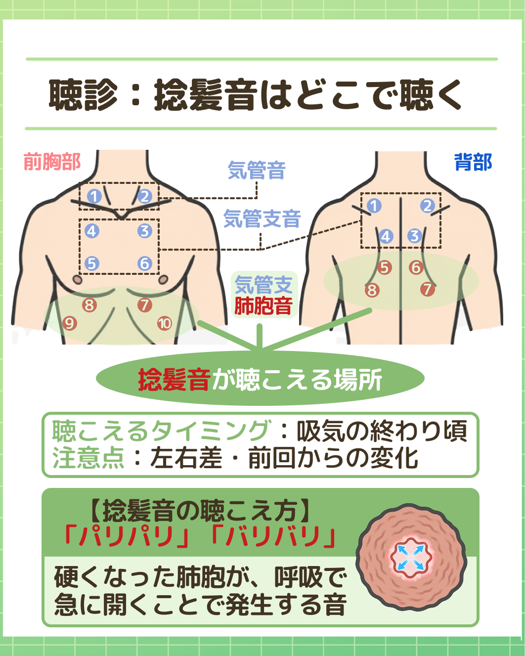 図解：聴診：捻髪音はどこで聴く。前胸部と背部の聴診位置イラストと、聴こえるタイミング（吸気の終わり頃）、注意点（左右差・前回からの変化）。【捻髪音の聴こえ方】「パリパリ」「バリバリ」硬くなった肺胞が呼吸で急に開くことで発生する音の説明。