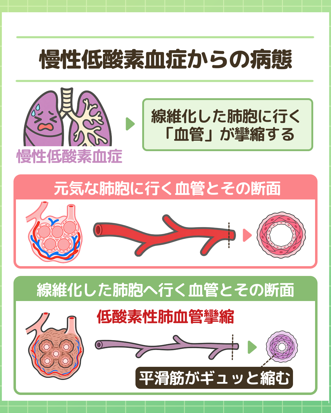 図解：なぜ慢性低酸素血症になるのか。元気な肺胞と線維化した肺胞のイラスト。低酸素性肺血管攣縮のしくみ：元気な肺胞へ酸素を効率よく運びたいため、線維化した肺胞へ行く血管が「攣縮」し、次第に肺全体の血管が狭くなって慢性低酸素血症に至る流れを解説。