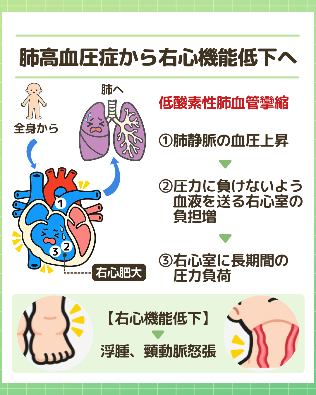 図解：肺高血圧症から右心機能低下へ。全身から肺への血流と、肺静脈の圧が高い期間が長期間続くことで、右心室は圧力に逆らい肺に血液を送り続け、右心室に長期間の圧力負荷がかかる流れ。右心機能低下により浮腫や頸動脈怒張が出現するイラスト。