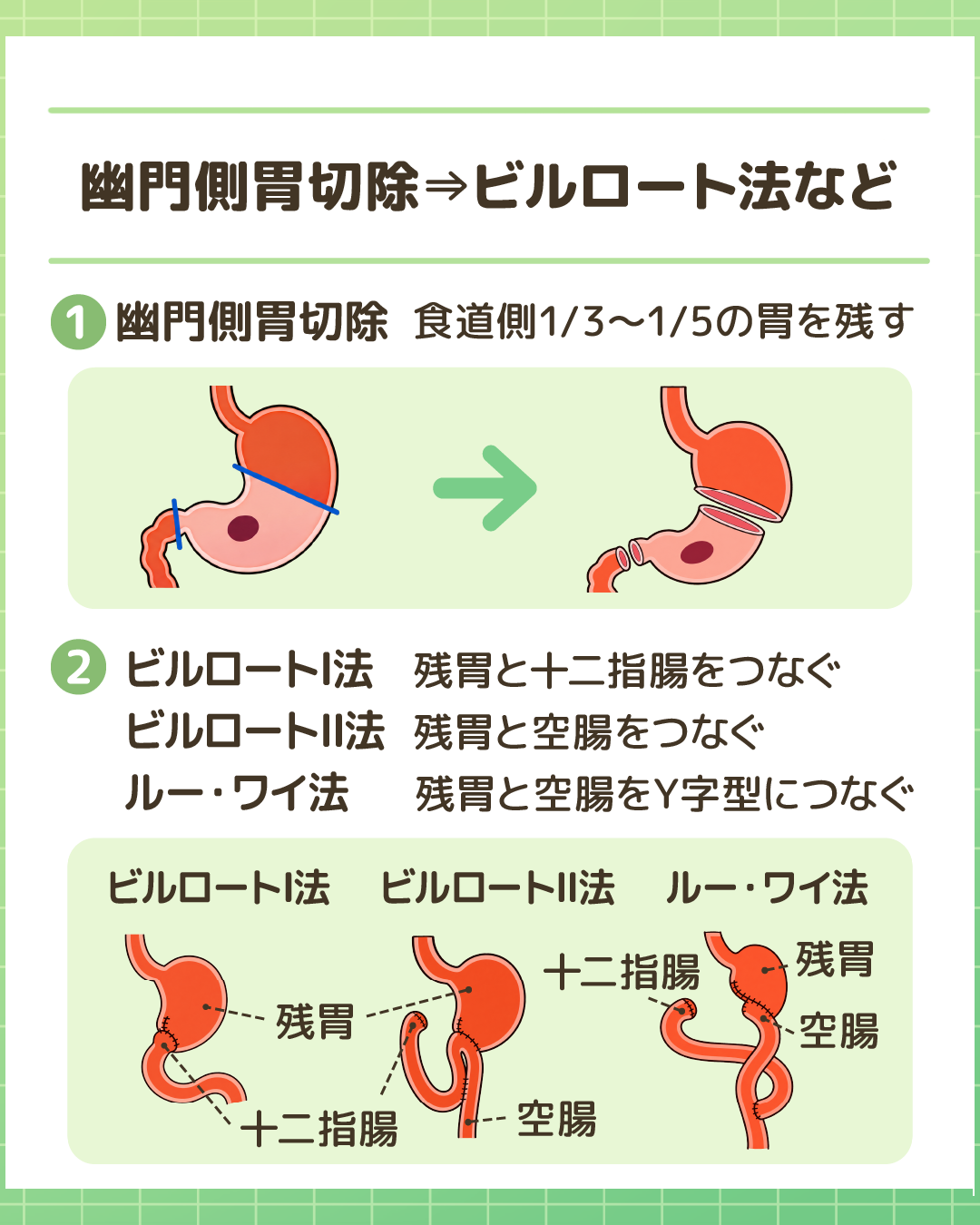 幽門側胃切除と再建術（ビルロート法など）。①幽門側胃切除の流れ、②残胃と十二指腸・小腸・空腸を再建するビルロートⅠ法・ビルロートⅡ法・ルー・ワイ法の構造イラスト。