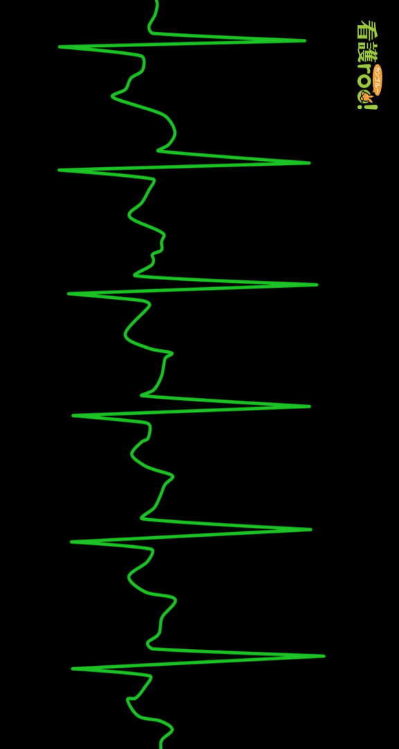 心房粗動（AFL）の波形の例