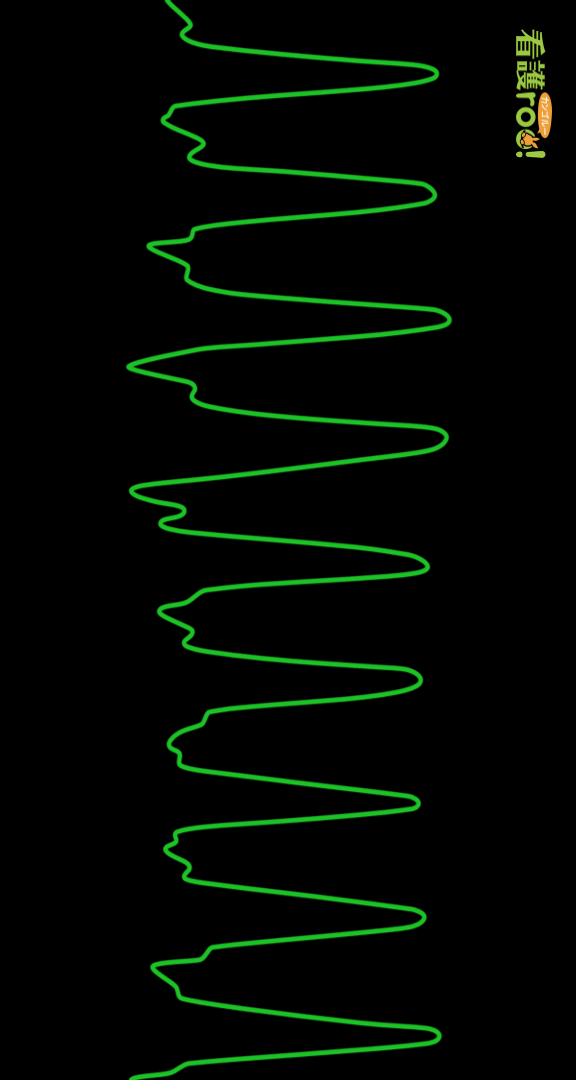 心室頻拍（VT）の波形の例