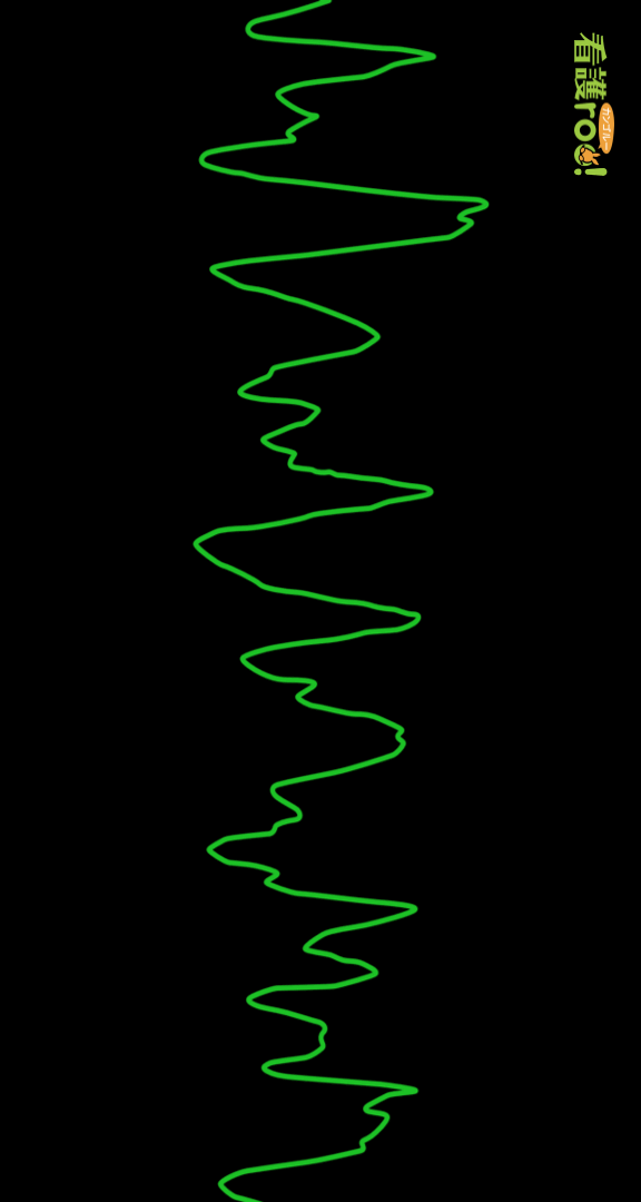 心室細動（VF）の波形の例