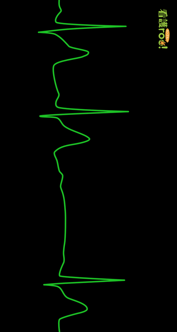 「Ⅱ度房室ブロック（モビッツⅡ型）」の波形の例