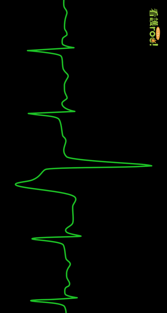 「心室期外収縮（PVC）」の波形の例