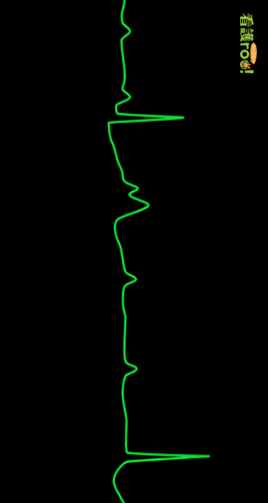 Ⅲ度房室ブロックの波形の例
