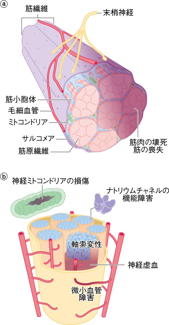 ICU-AW の病態メカニズム