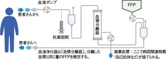 血漿交換の回路のしくみ