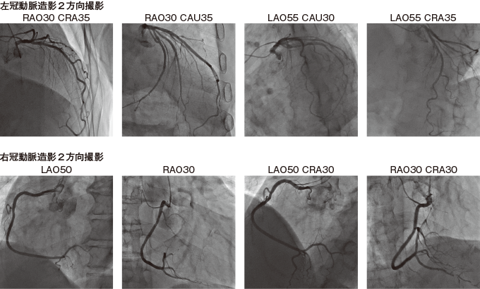 冠動脈造影画像