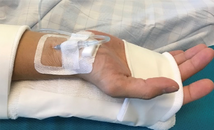 MDRPU 発生の予防