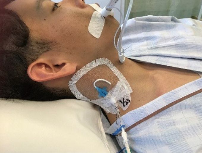 末梢静脈・動脈ラインの固定