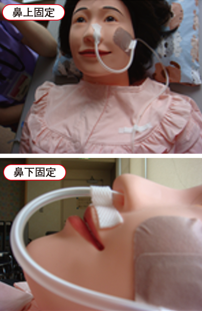 胃管カテーテルの固定