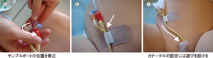 膀胱留置カテーテルの固定