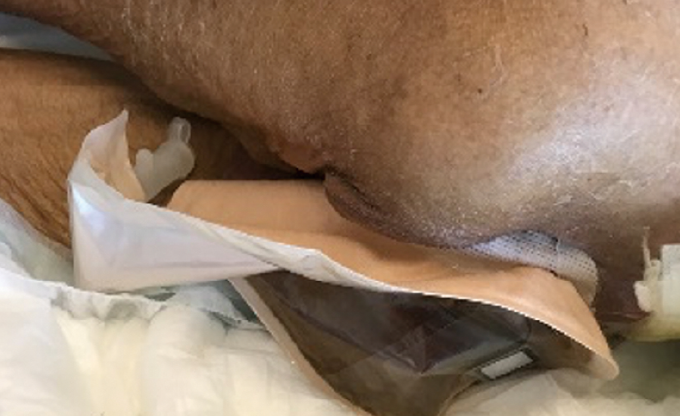 ストーマ装具によるパウチング