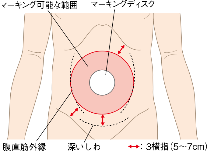 マーキングが可能な位置