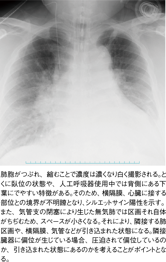 画像診断｜ICU看護実践マニュアル | 看護roo![カンゴルー]