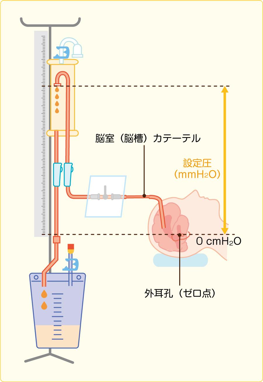 脳室ドレーン 看護Roo: 脳神経外科 ドレーン管理 看護 – ドレーン・カテーテル・チューブ管理 – JRWP