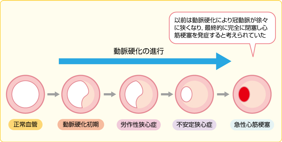 急性冠症候群 (きゅうせいかんしょうこうぐん) JapaneseEnglish Dictionary JapaneseClass.jp