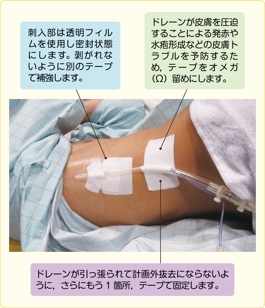 開胸術後患者の観察ポイント｜看護roo![カンゴルー]
