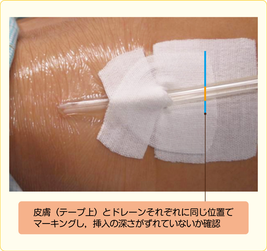 刺入部観察項目 – カテーテル刺入部 観察項目 – PNFW