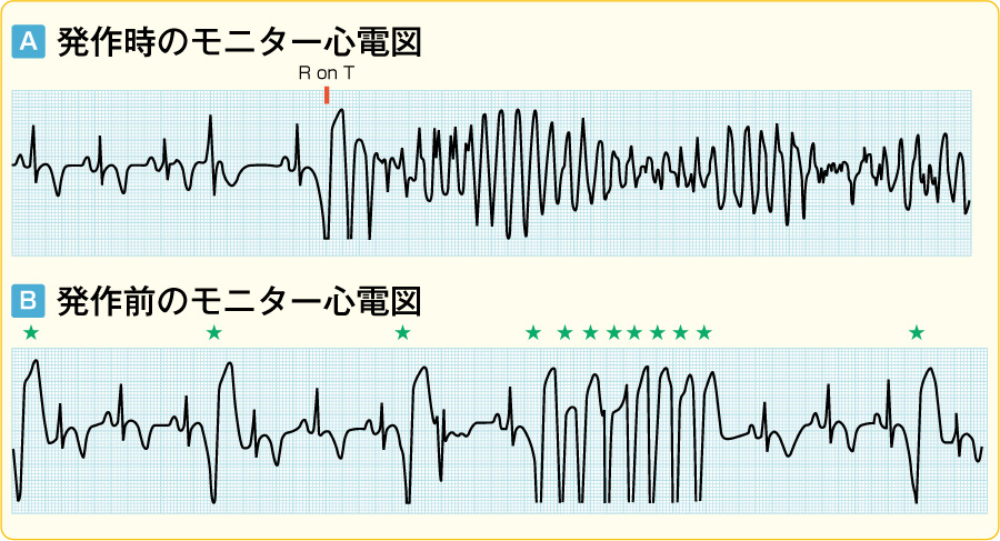 トルサード ド ポワント心電図