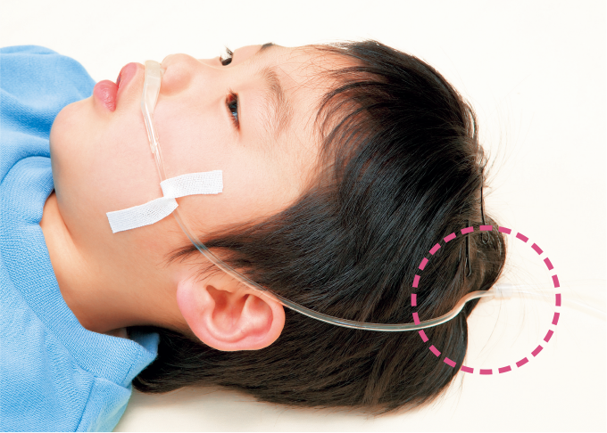 頬に固定用テープでとめる