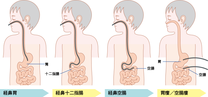 よく用いられる経管栄養法