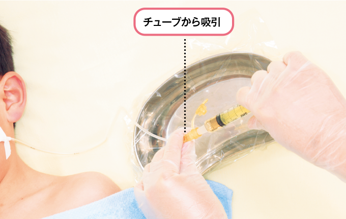 チューブから吸引する
