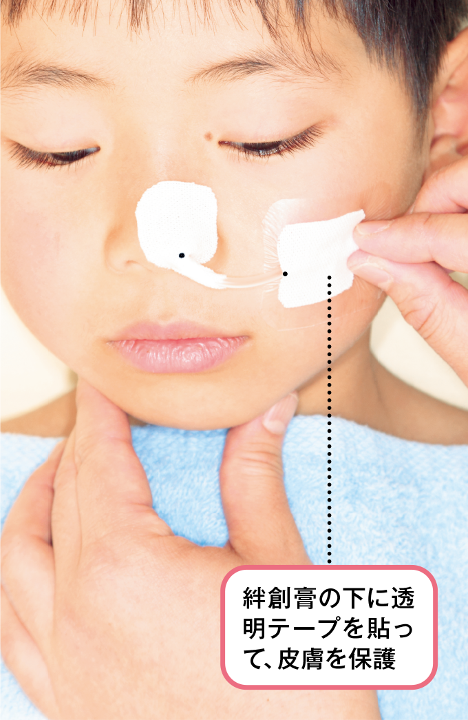 チューブを頬で1箇所固定してマーキングを追加する