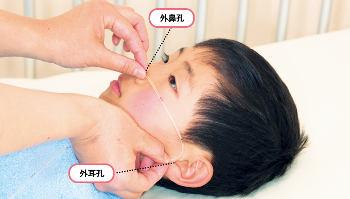 チューブ末端を患児の外鼻孔に置き頬に沿わせて、外耳孔までたどる