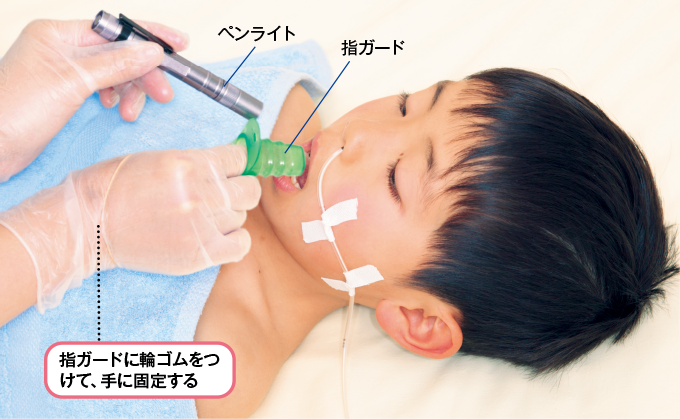 指ガードを装着して舌を押さえペンライトで照らす