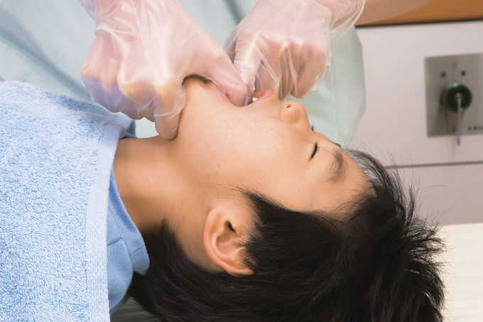 口腔内異物除去法