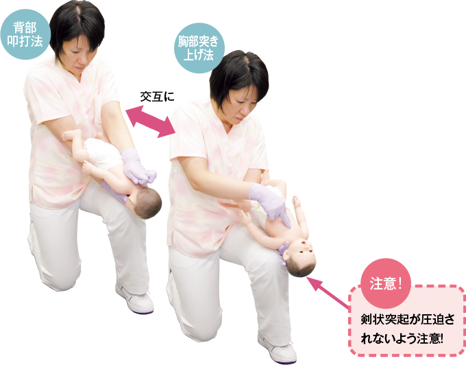 乳児の気道異物除去