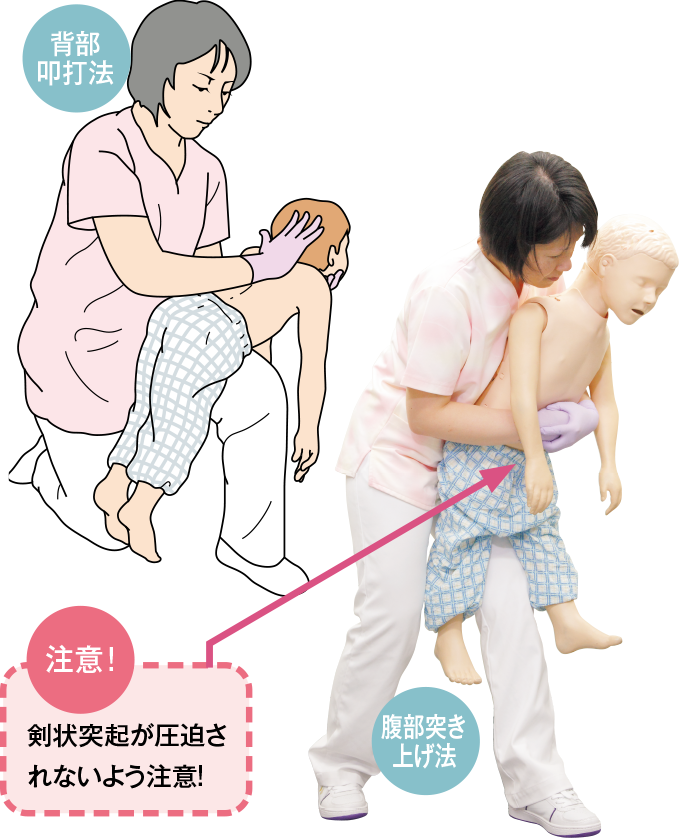 小児の気道異物除去