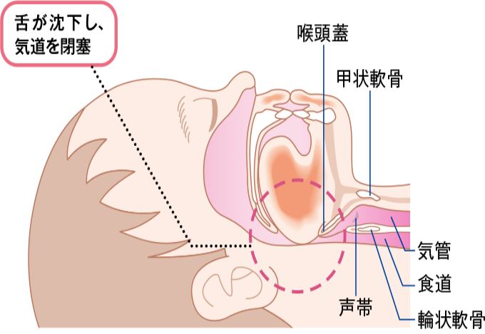 舌が沈下し気道が閉塞する