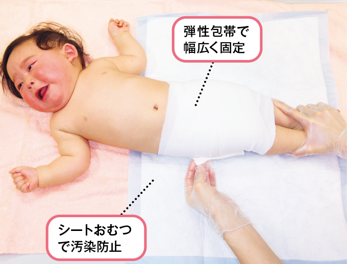 弾性包帯で大腿部を固定する