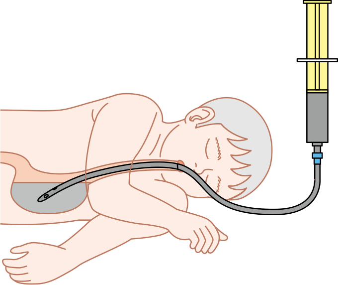 胃洗浄は4時間以内に行う