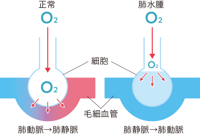 肺水腫に伴うガス交換障害を表した図