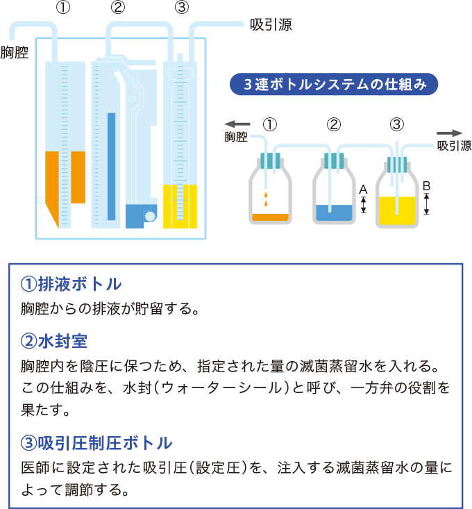 チェスト・ドレーン・バックの原理を表した図