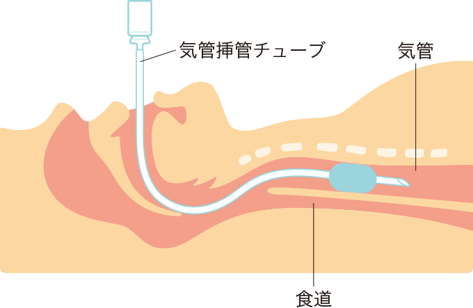 気管挿管時の状態を表した図