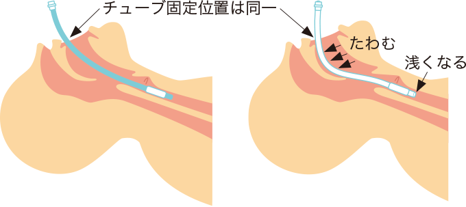 気管チューブのたわみと脱出を表した図