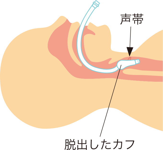 気管チューブカフの声門からの脱出を表した図