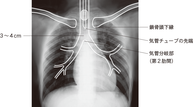胸部X線を表した図
