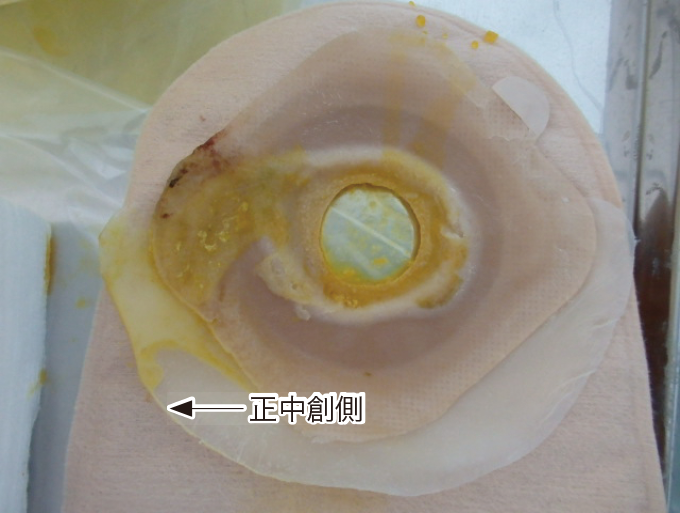 漏れがあった装具を表した写真