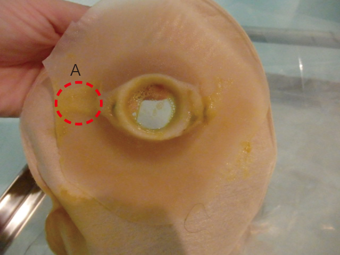 装具を変更したが再び漏れた写真