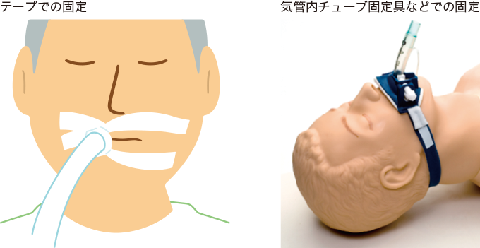 チューブ固定のさまざまな方法を表した図